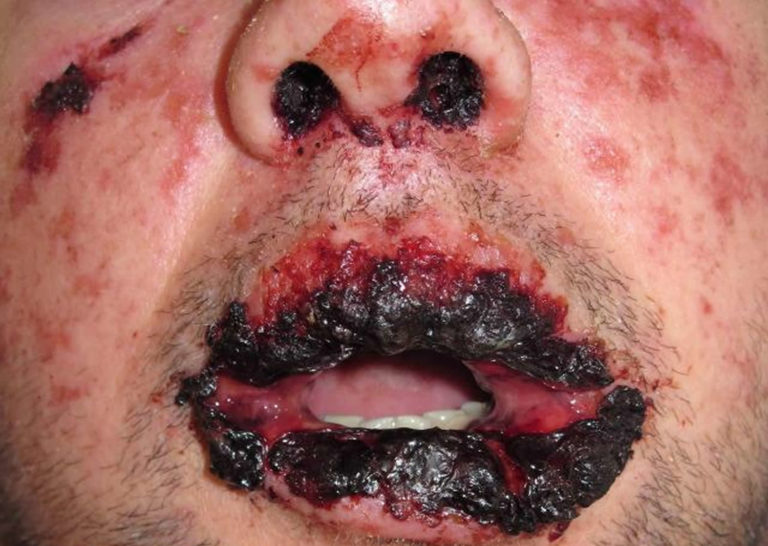 Stevens Johnson Syndrome SJS Causes, Symptoms, Treatment