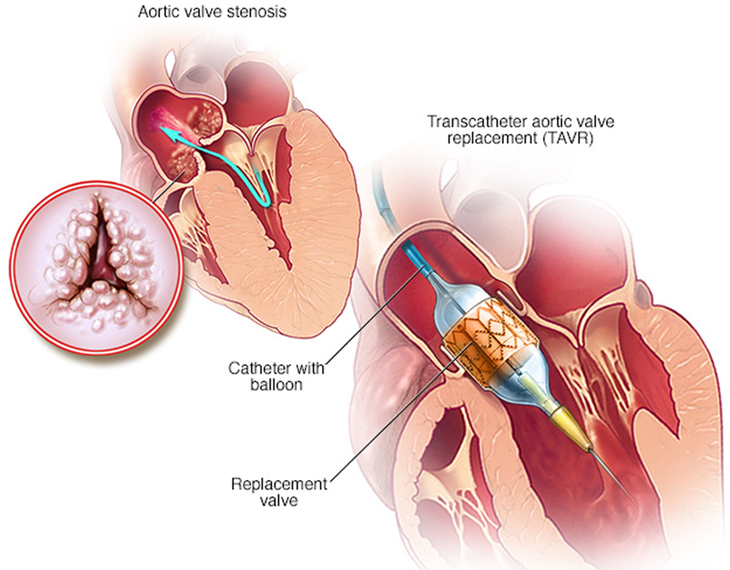 Life Expectancy After Heart Valve Repair