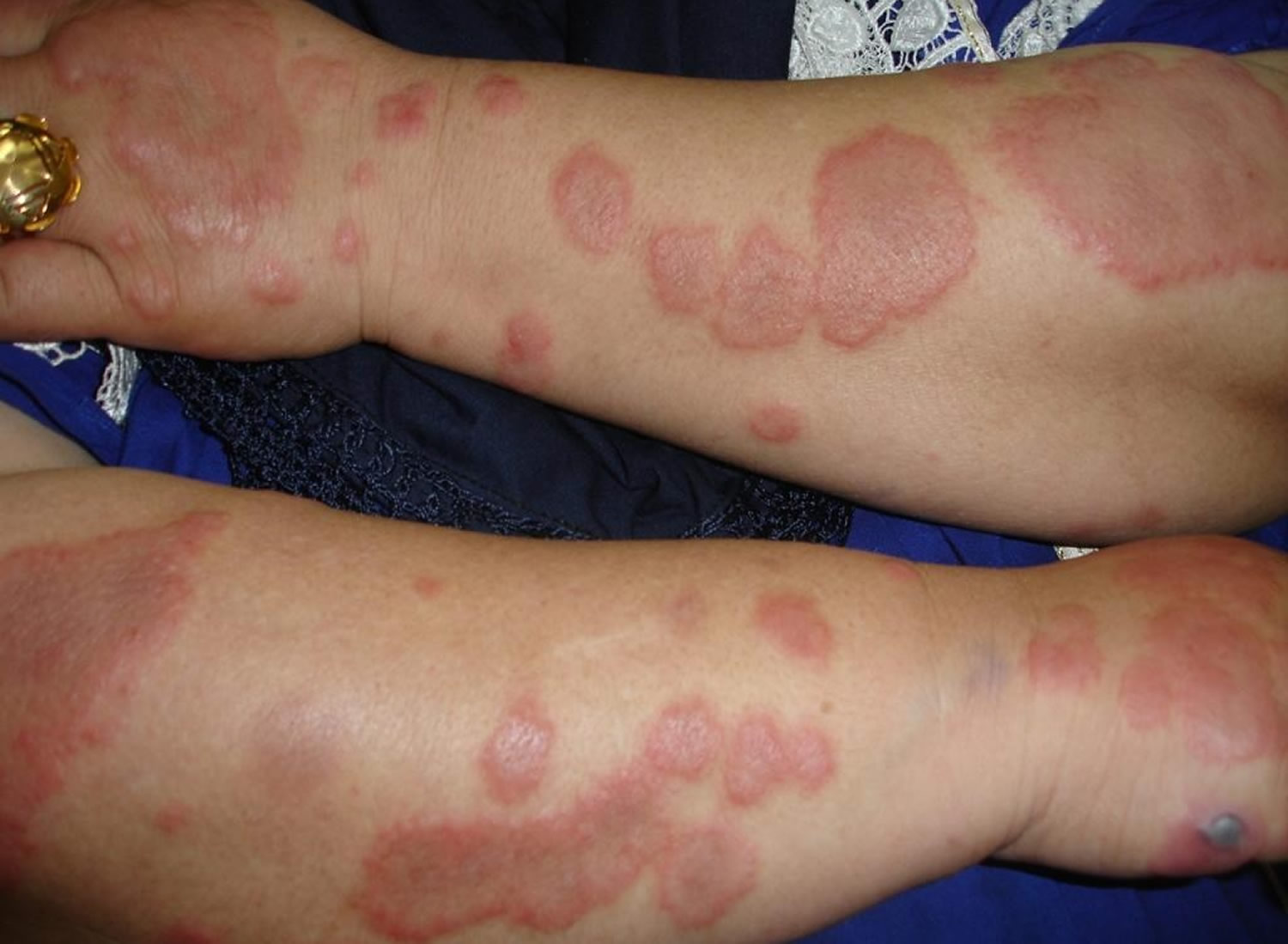 valley-fever-coccidioidomycosis-causes-symptoms-treatment