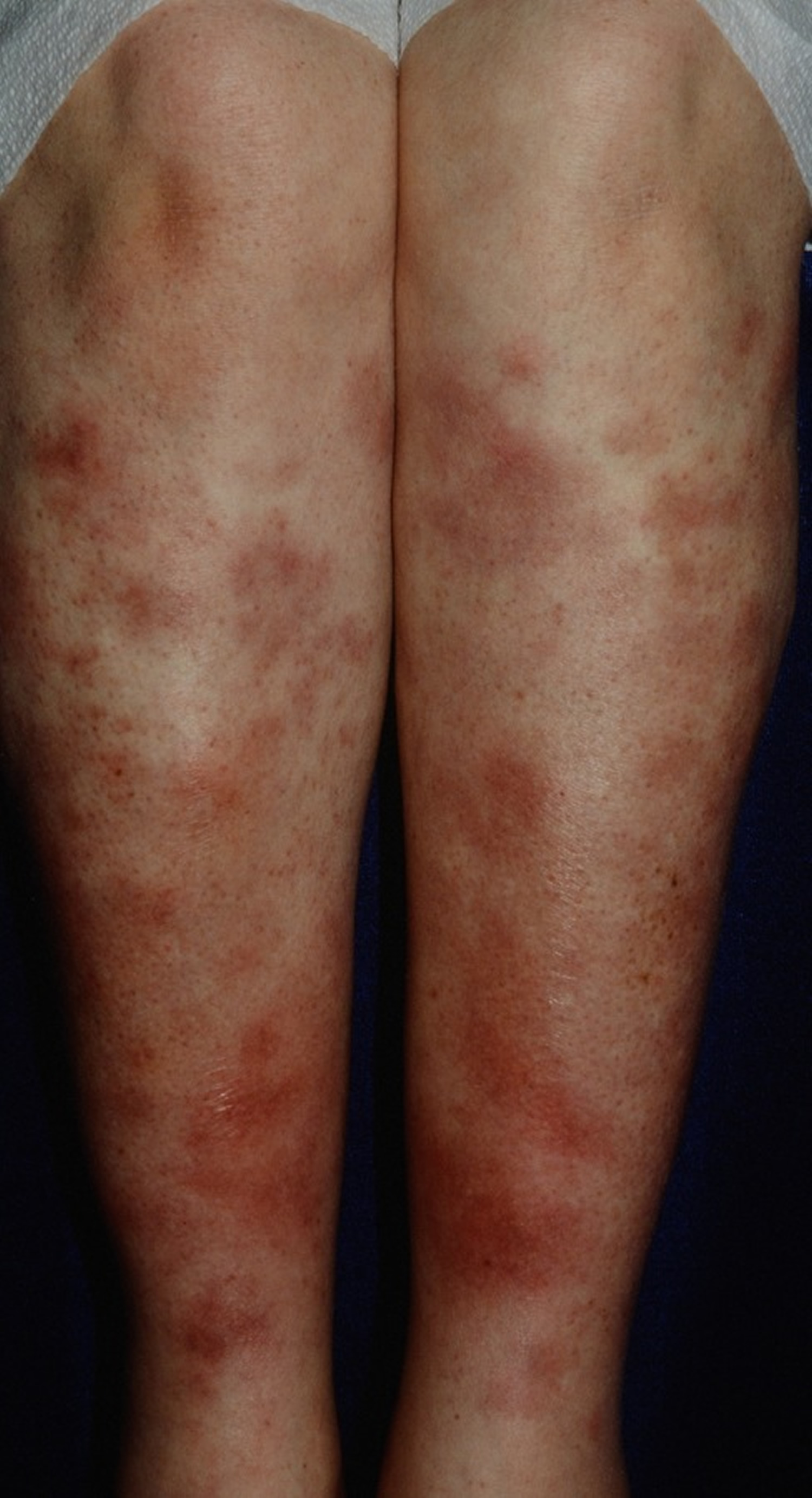 Valley fever rash - Erythema nodosum