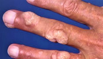 Wart on finger