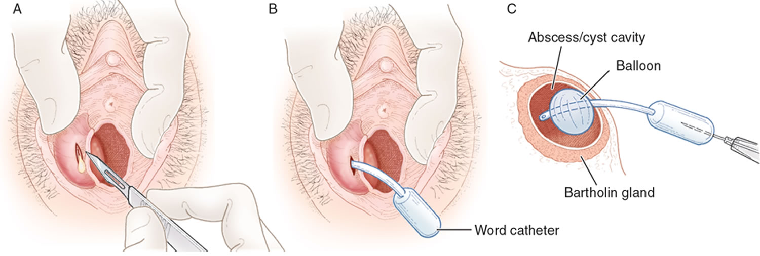 Word catheter insertion procedure