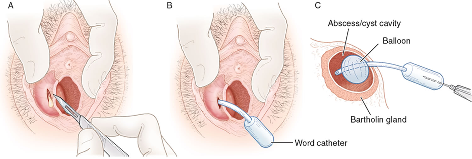 Как выглядит удалите. Word катетер бартолиновой железы. Бартолиновая железа киста. Word-катетер для бартолиновых желез. Бартолиновая железа воспаление.
