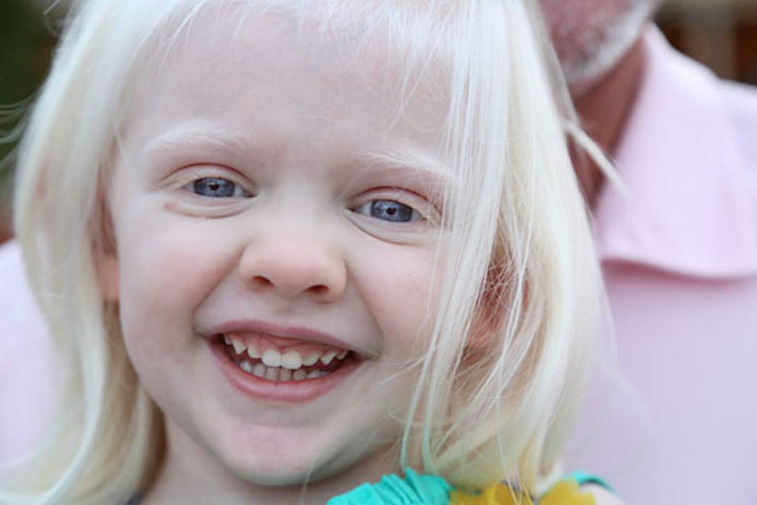 albinism genetics disorder