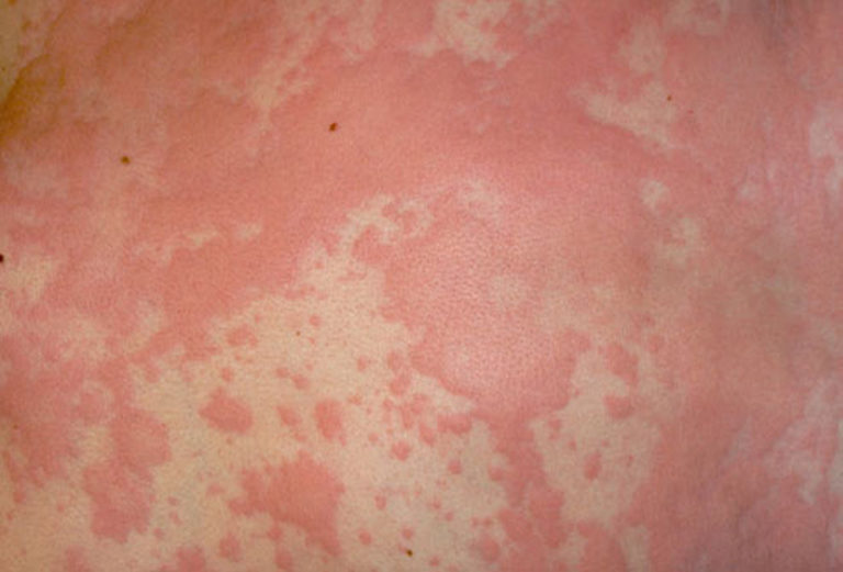 Can Alcohol Allergy Cause Hives