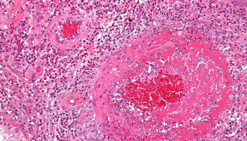 anca vasculitis