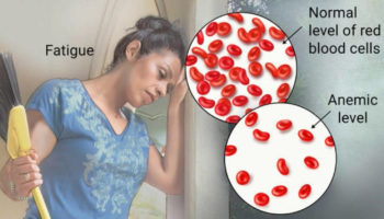 anemia