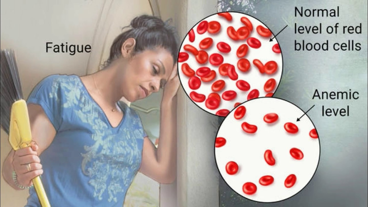 Anemia Causes Types Signs Symptoms Diagnosis Test And Treatment 