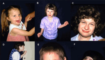 angelman syndrome