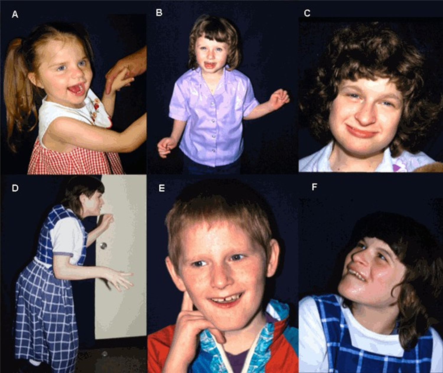 Angelman Syndrome Causes Symptoms Life Expectancy Treatment