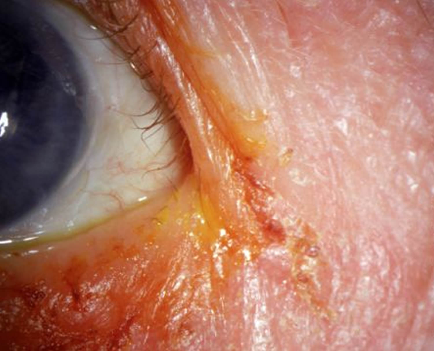 Blepharitis - Causes, Signs and Symptoms, Home Remedies & Treatment