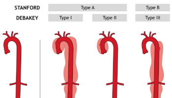 aortic dissection