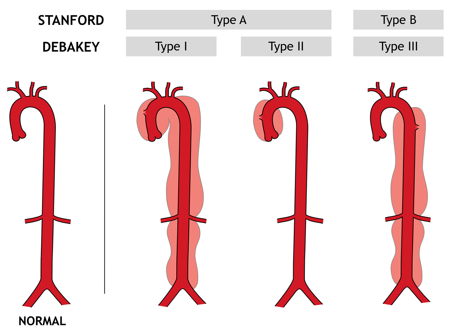 Aortic Dissection Type A And B Symptoms Causes Treatment