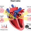 aortic valve disease