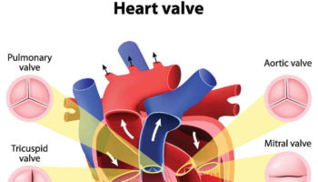aortic valve disease