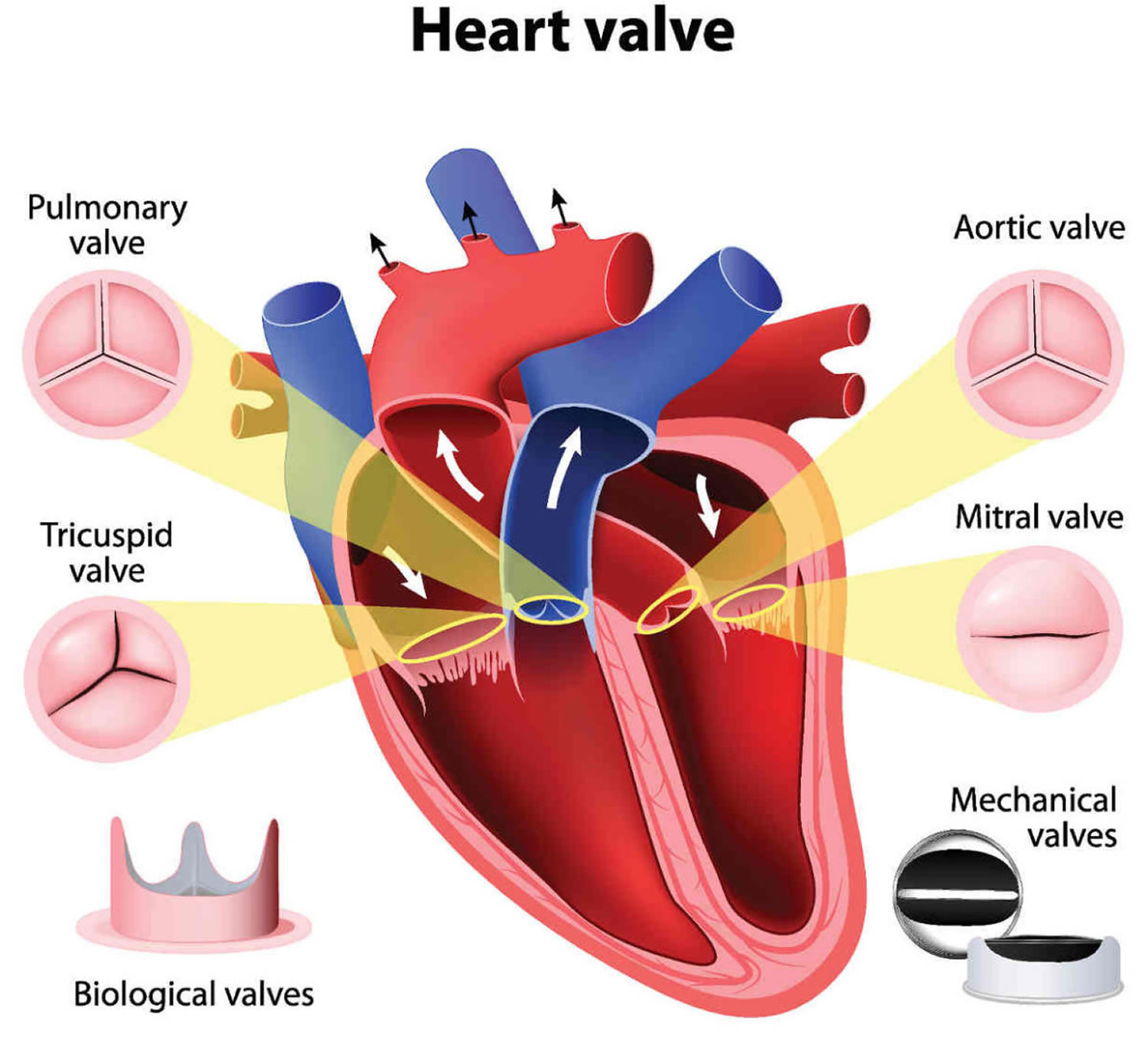 Bicuspid Aortic Valve Types