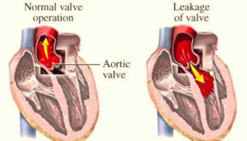aortic valve regurgitation
