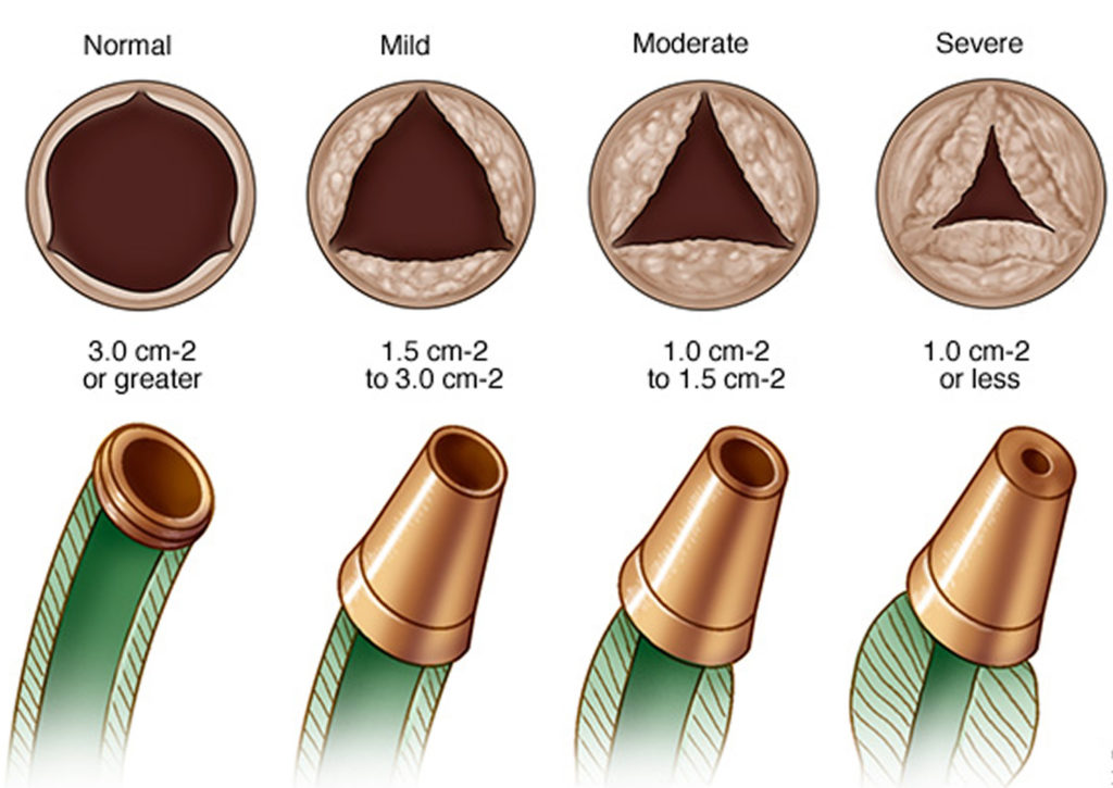 Aortic Valve Stenosis Causes Symptoms Life Expectancy Treatment