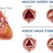 aortic valve stenosis