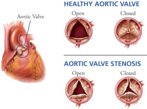 Aortic Valve Stenosis - Causes, Symptoms, Life Expectancy, Treatment