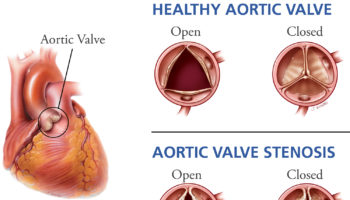 aortic valve stenosis