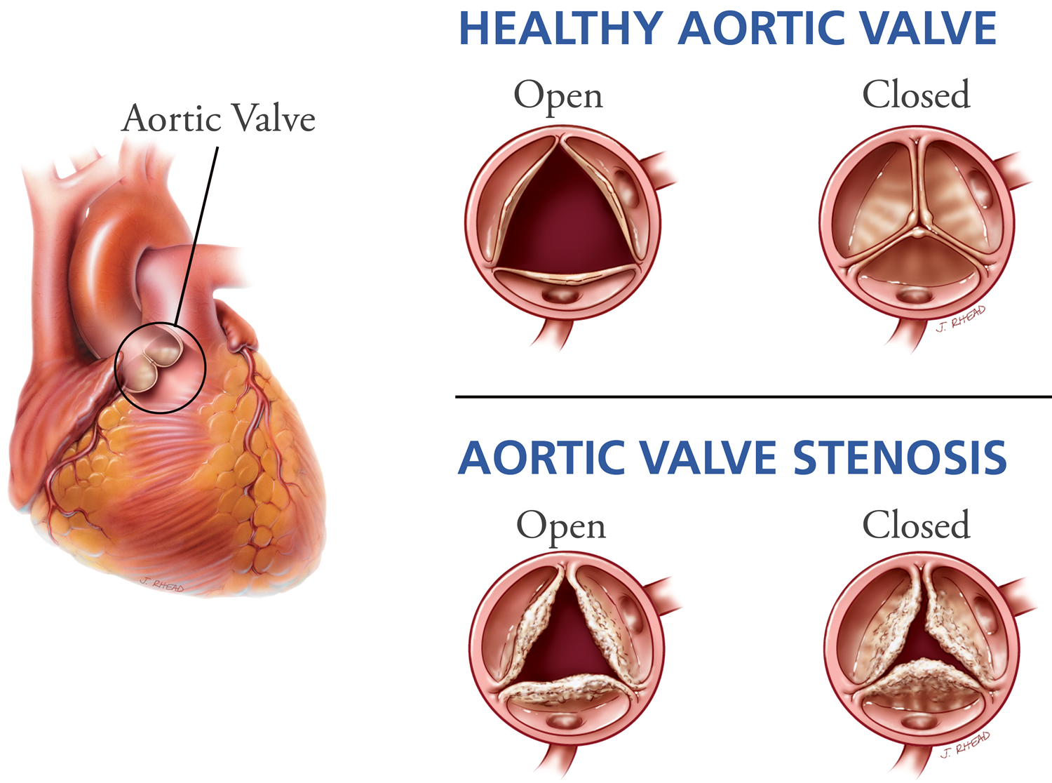 Aortic Valve Anatomy