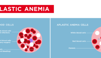aplastic anemia