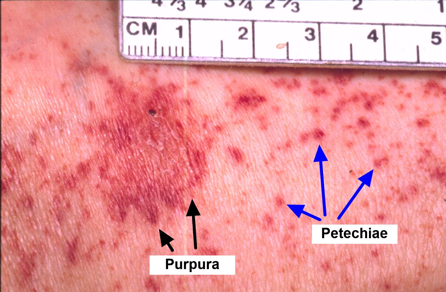 aplastic-anemia-causes-signs-symptoms-life-expectancy-treatment