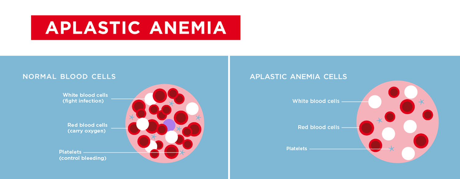 case study aplastic anemia