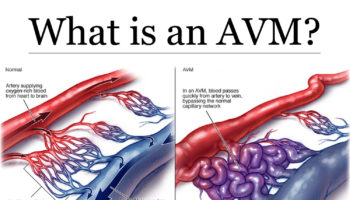 arteriovenous-malformation