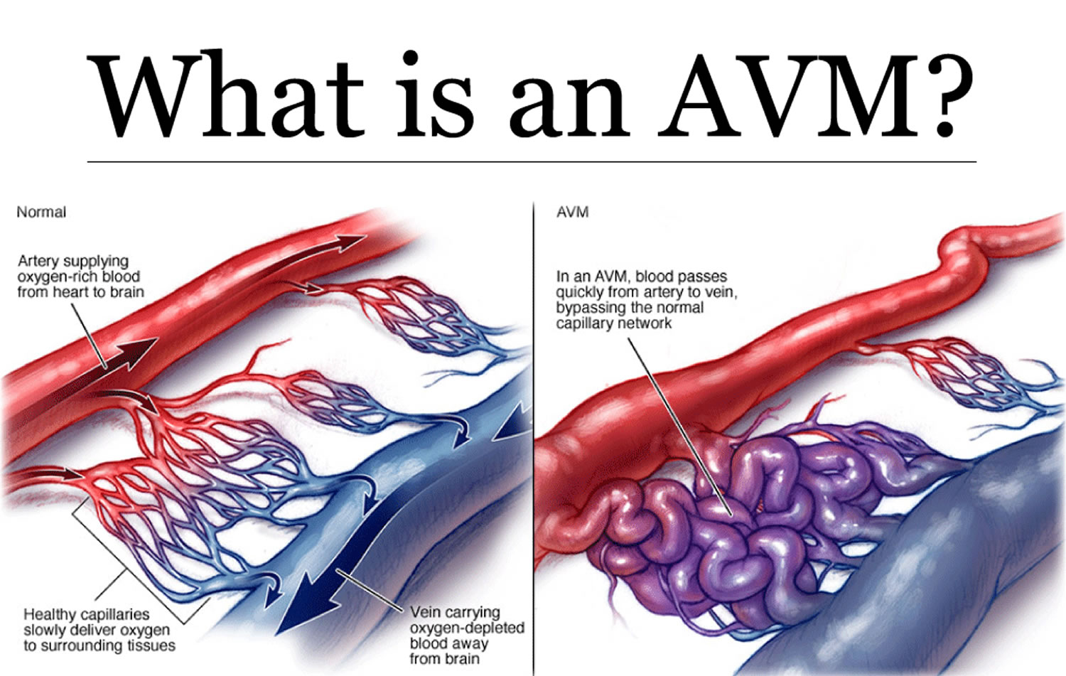 Brain Avm Arteriovenous Malformation Symptoms And