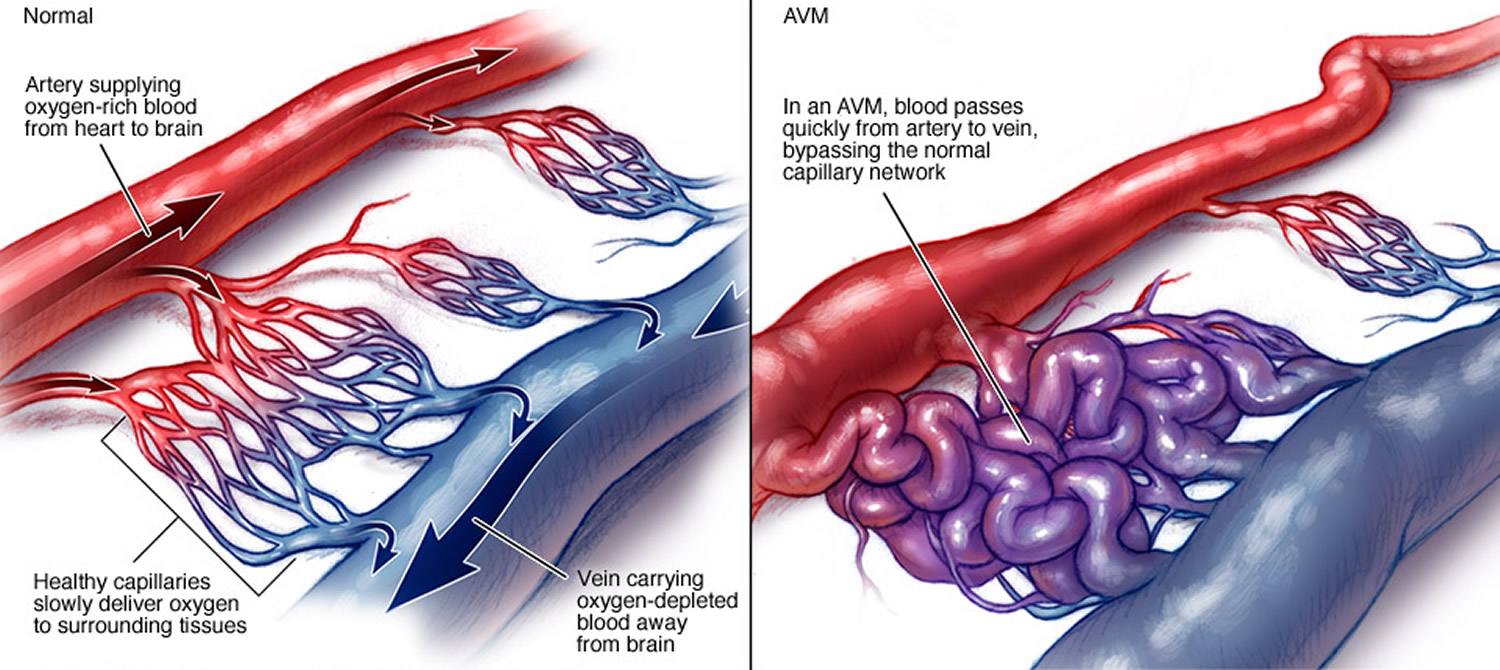 arteriovenous-malformation-brain-avm-causes-symptoms-treatment