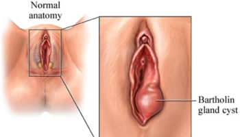 bartholin cyst