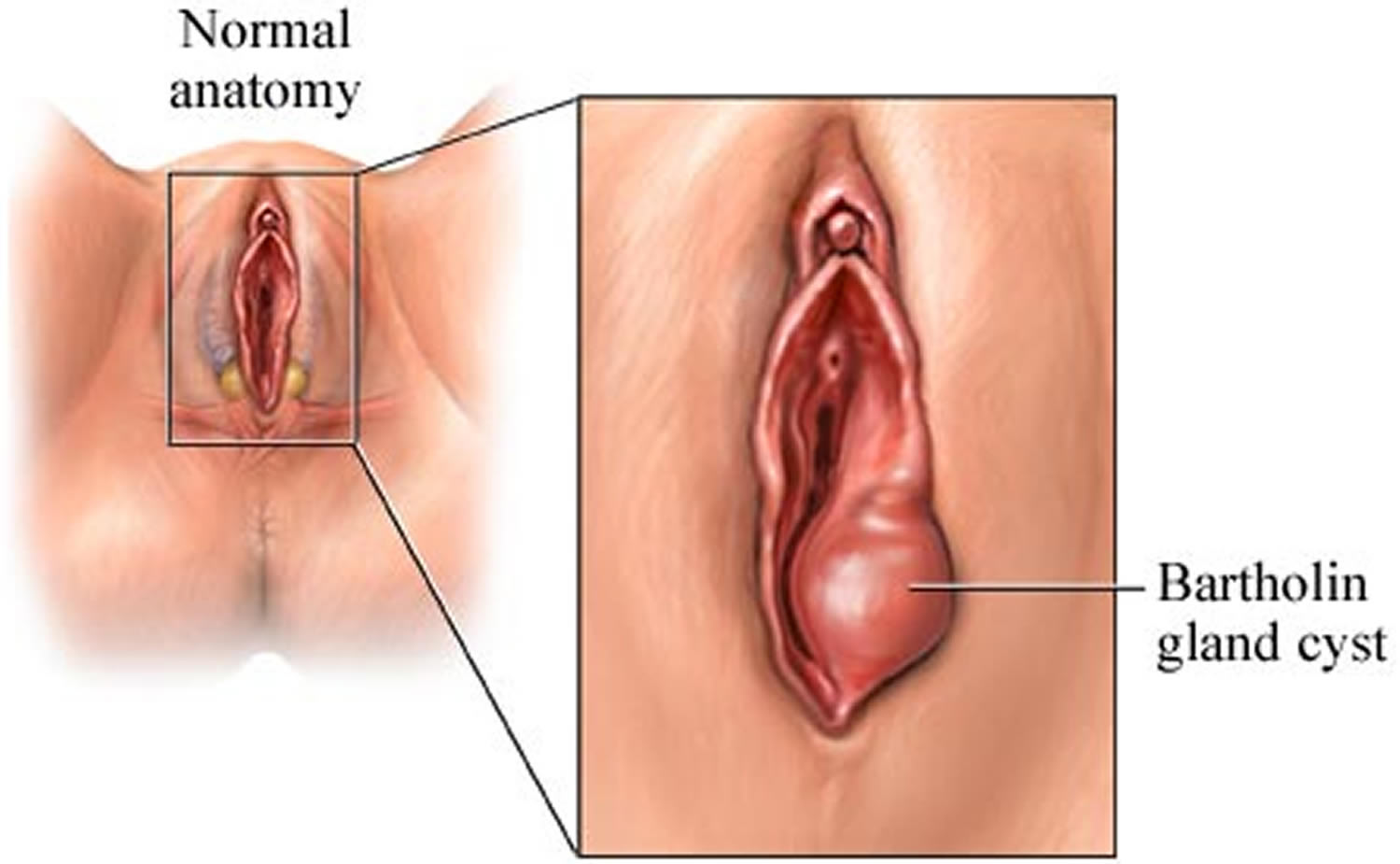 kista bartholin gambar kista bartholin kista bartholin bisa sembuh sendiri antibiotik untuk kista bartholin bentuk kista bartholin
