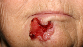 basal cell carcinoma – large untreated