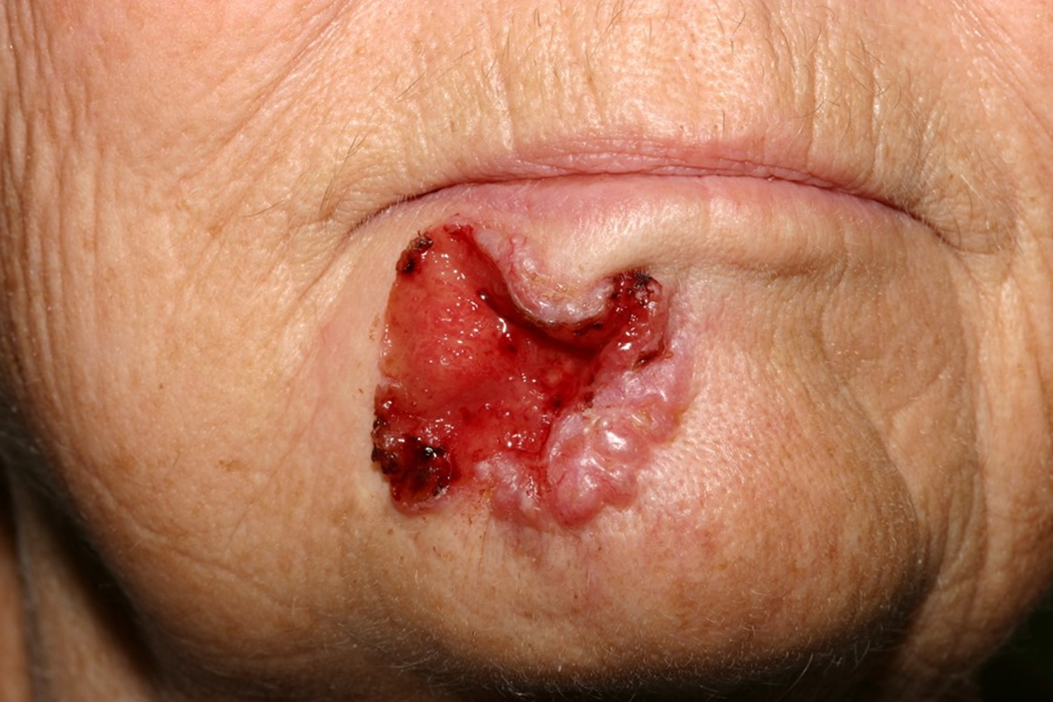 Basal Cell Carcinoma Nose Treatment