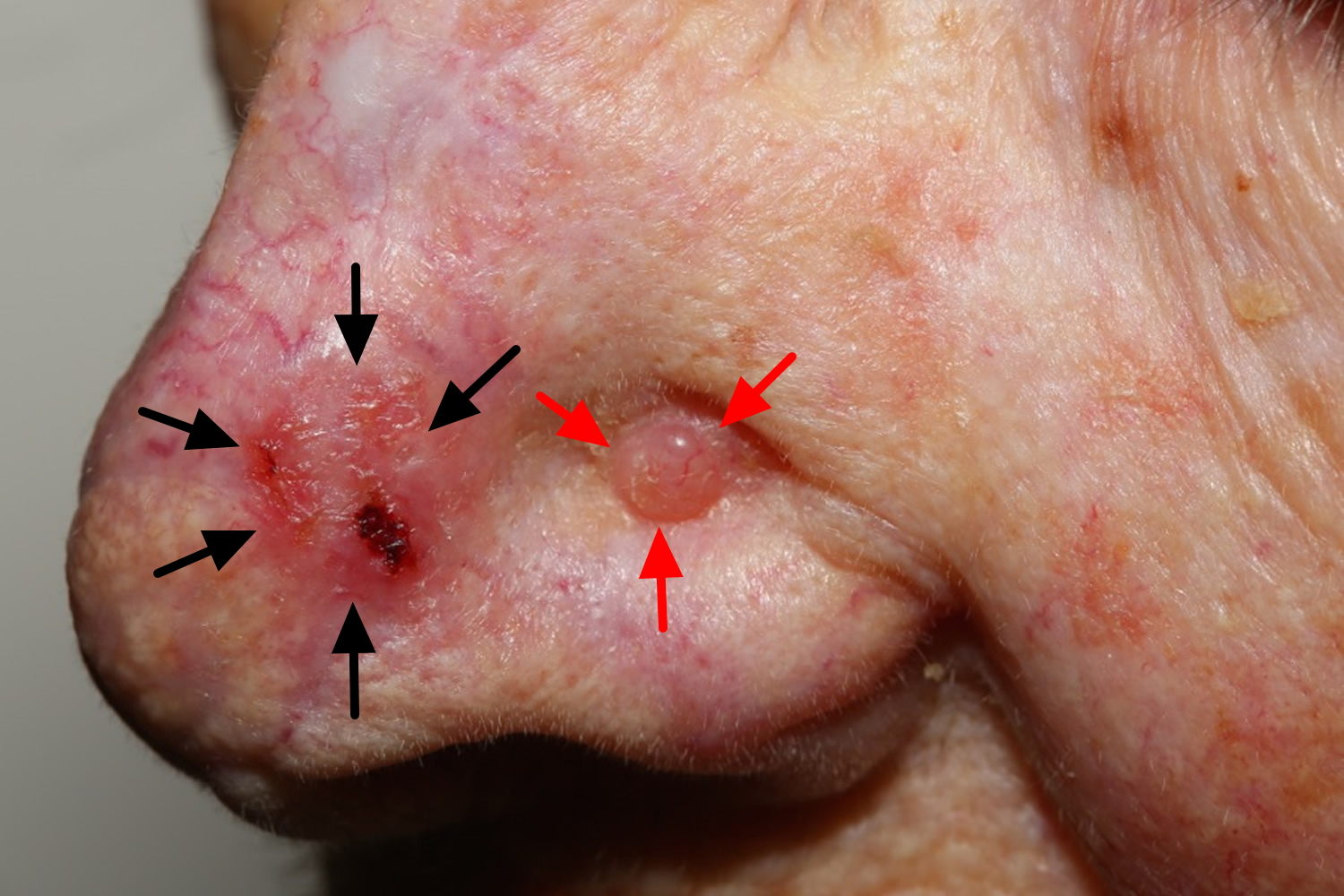 Basal Cell Carcinoma Causes Types Symptoms Prognosis Treatment