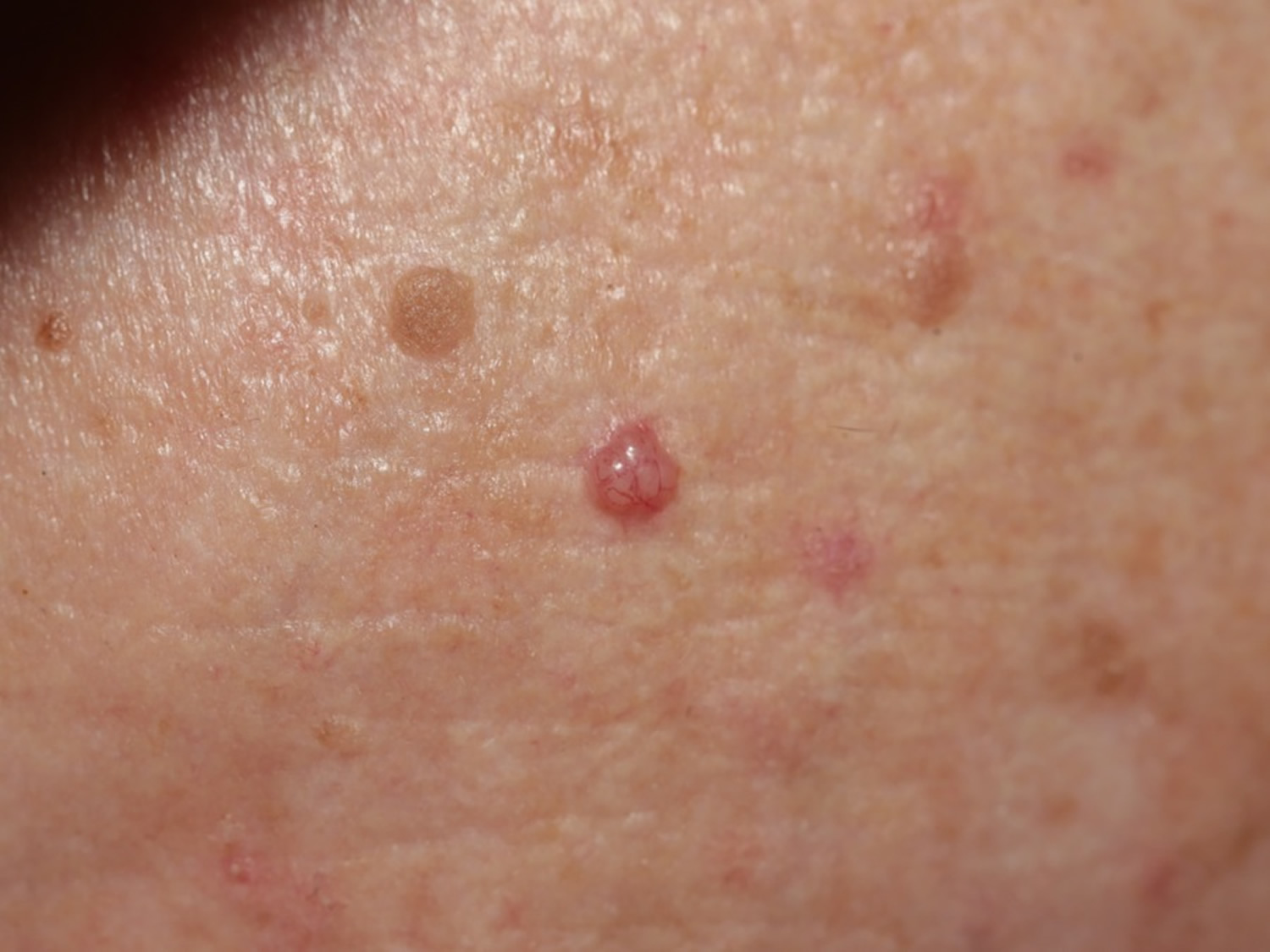 Basal Cell Carcinoma Causes, Types, Symptoms, Prognosis, Treatment