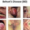 behcet’s disease