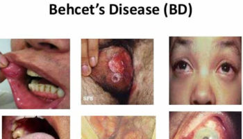behcet’s disease