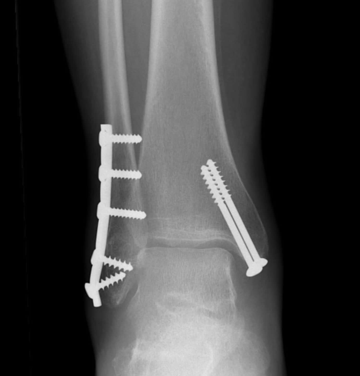 broken ankle xray