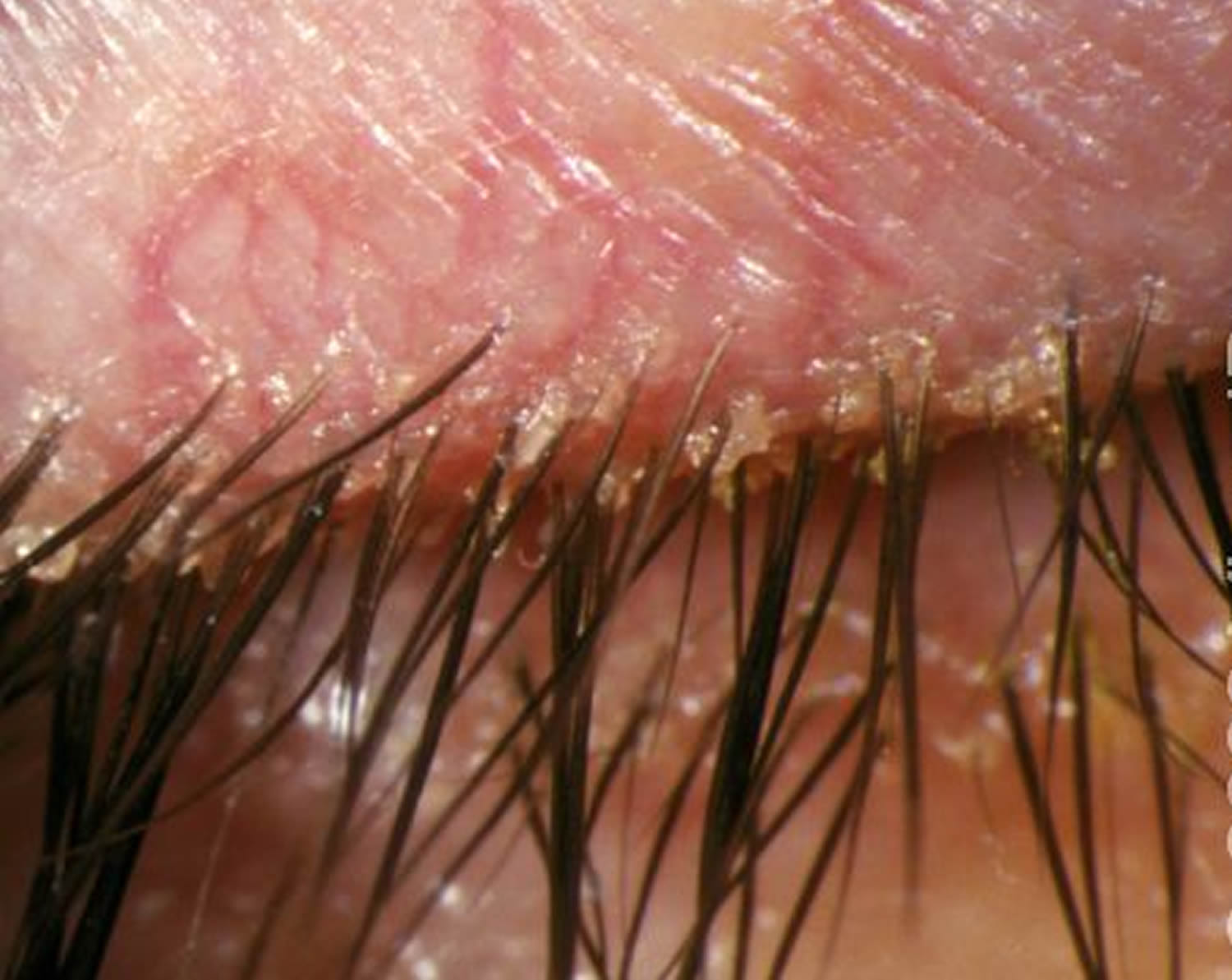 blepharitis