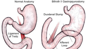 blind loop syndrome