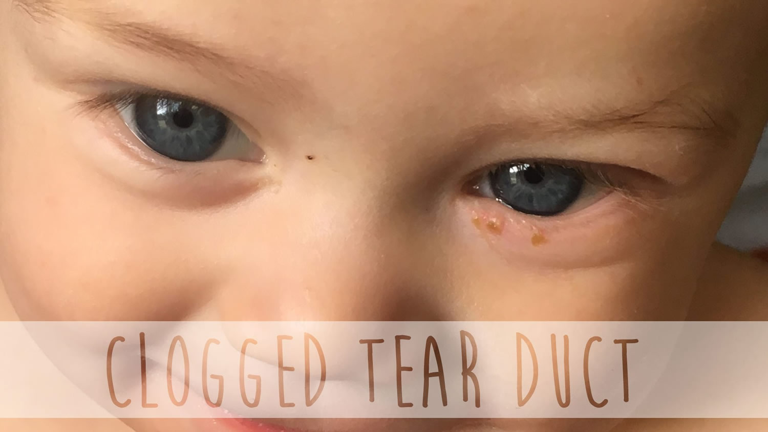 Blocked Tear Duct - Baby, Newborn, Adults - Symptoms & Treatment