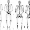 bone metastasis