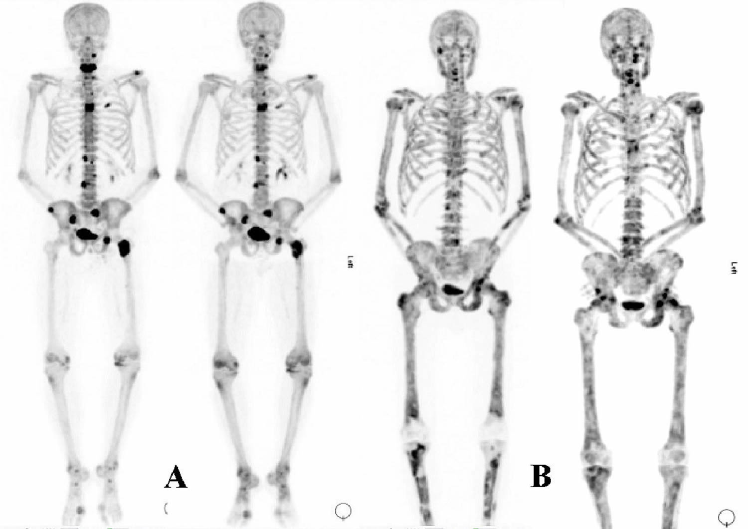 Prostate Cancer Bone Mets Survival