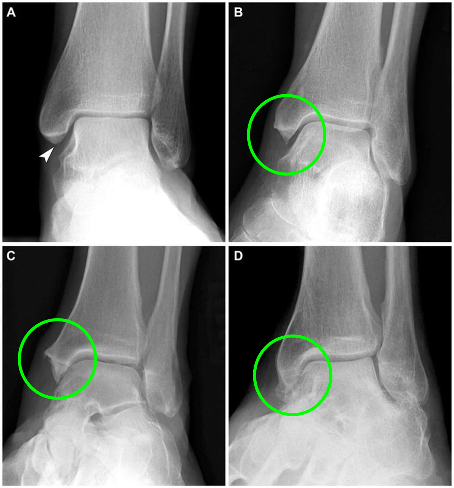 Bone Spur Osteophytes, Causes, Signs, Symptoms & Treatment