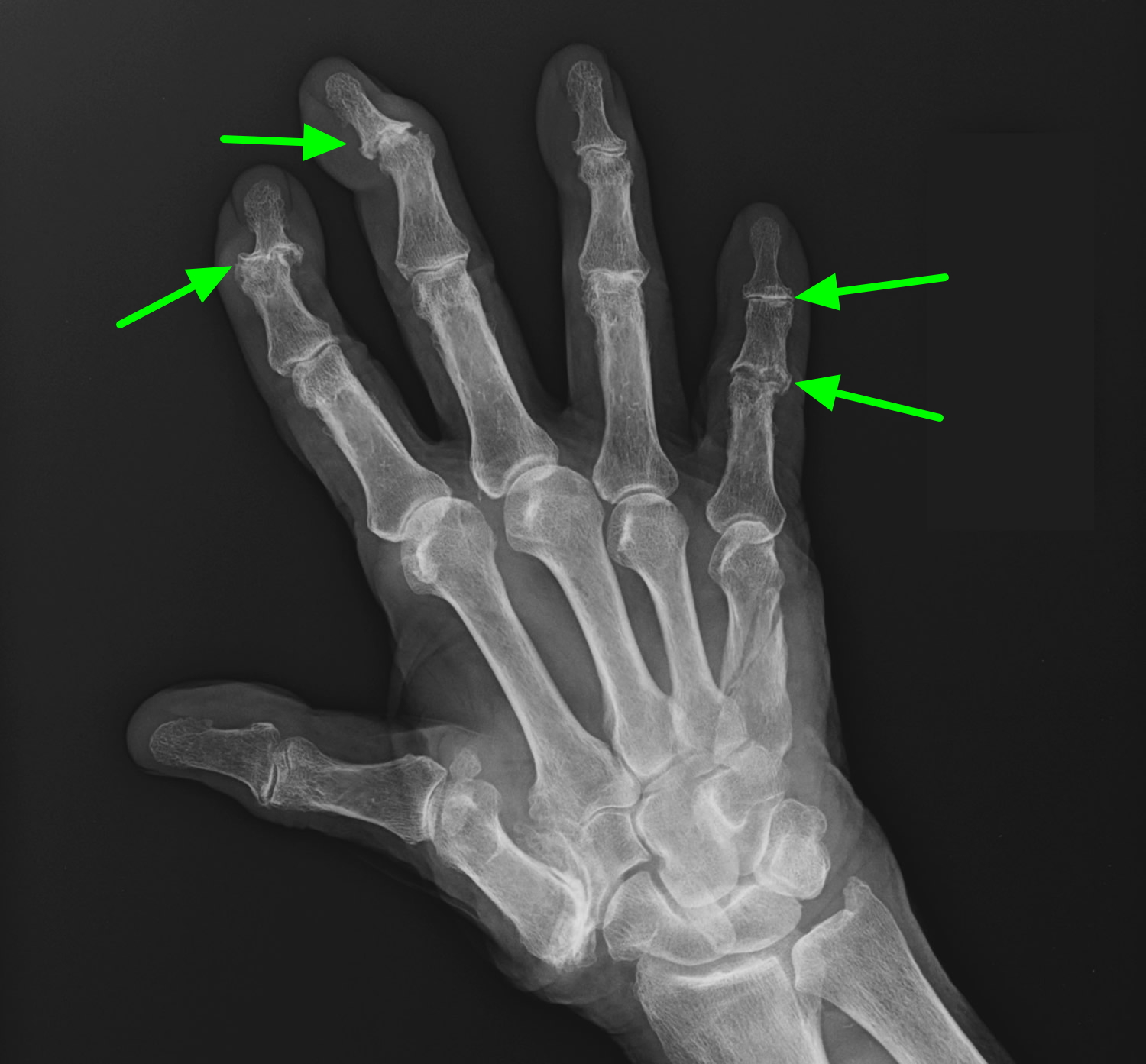 Bone Spur Osteophytes Causes Signs Symptoms And Treatment 2046