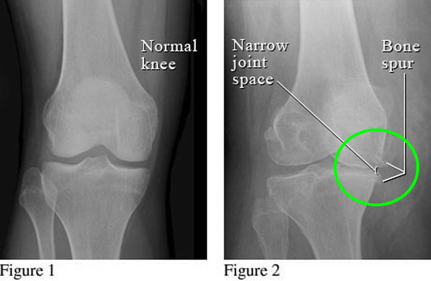 bone spur knee.