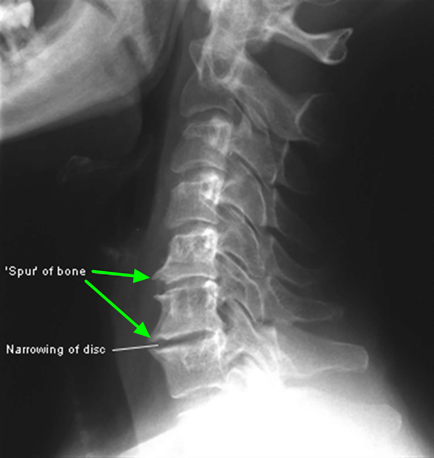 Bone Spur - Osteophytes, Causes, Signs, Symptoms & Treatment